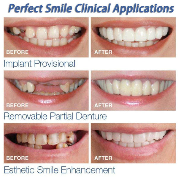 Instant Perfect Smile Dental Veneers - dreamcatcherbutik